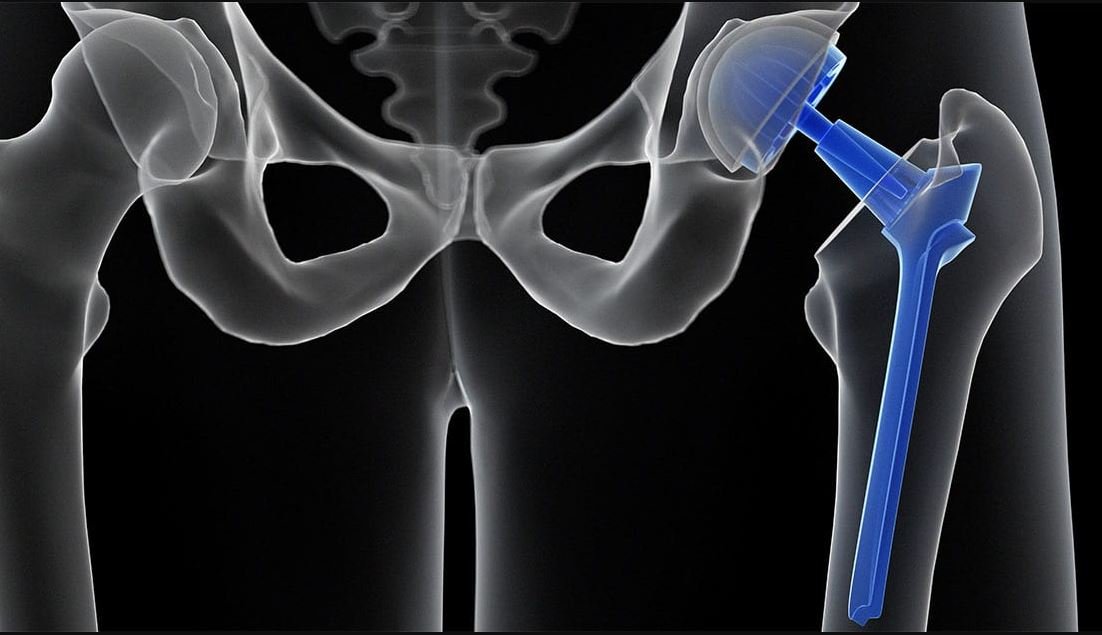 Avn Hip Replacement